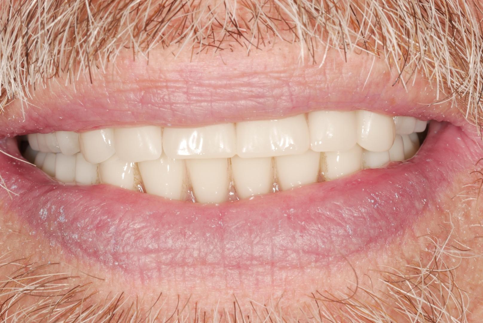 64c1a1a932cc144f09ff58c7 Case 4 After